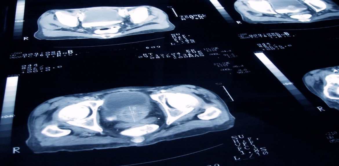 Descubren un nuevo método más eficaz para detectar cáncer de próstata