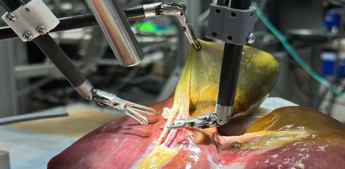 Un robot con IA realiza extirpación de vesícula con precisión total y sin ayuda humana